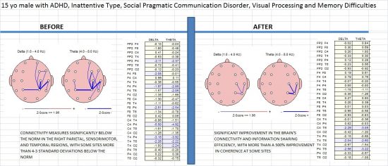 PRE-POST CONNECTIVITY COMPARISON