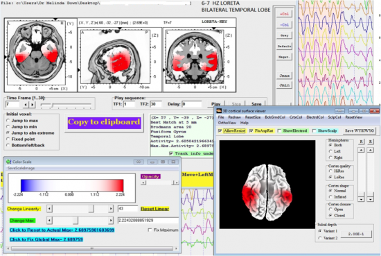 QEEG Brain Mapping - Restore Behavioral Health