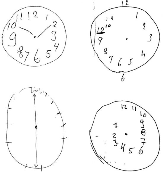 clock+drawing+test+dementia