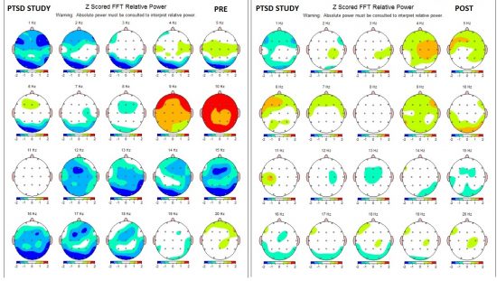 PRE-POST PTSD STUDY COMPARISON